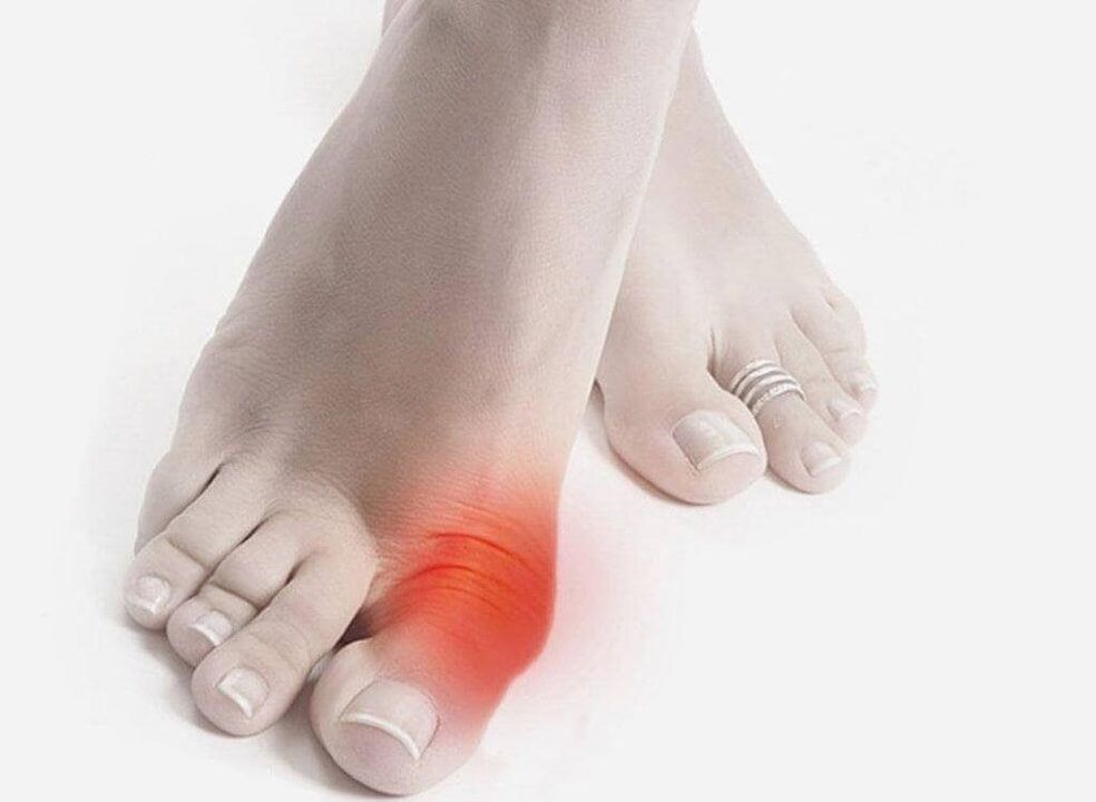 foot gout symptoms